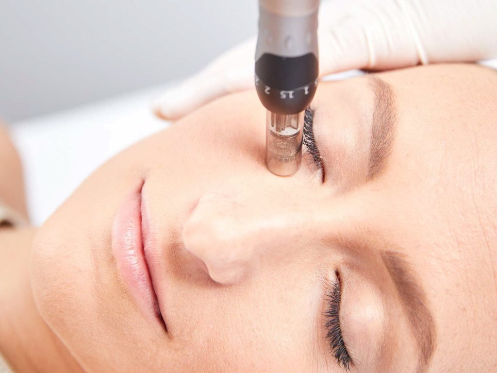 skin needling